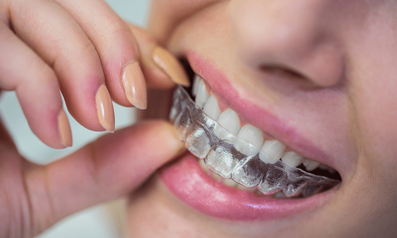 um close up dos dentes com alinhador invisivel