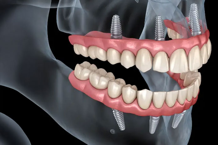 Dentes fixos all-on-4